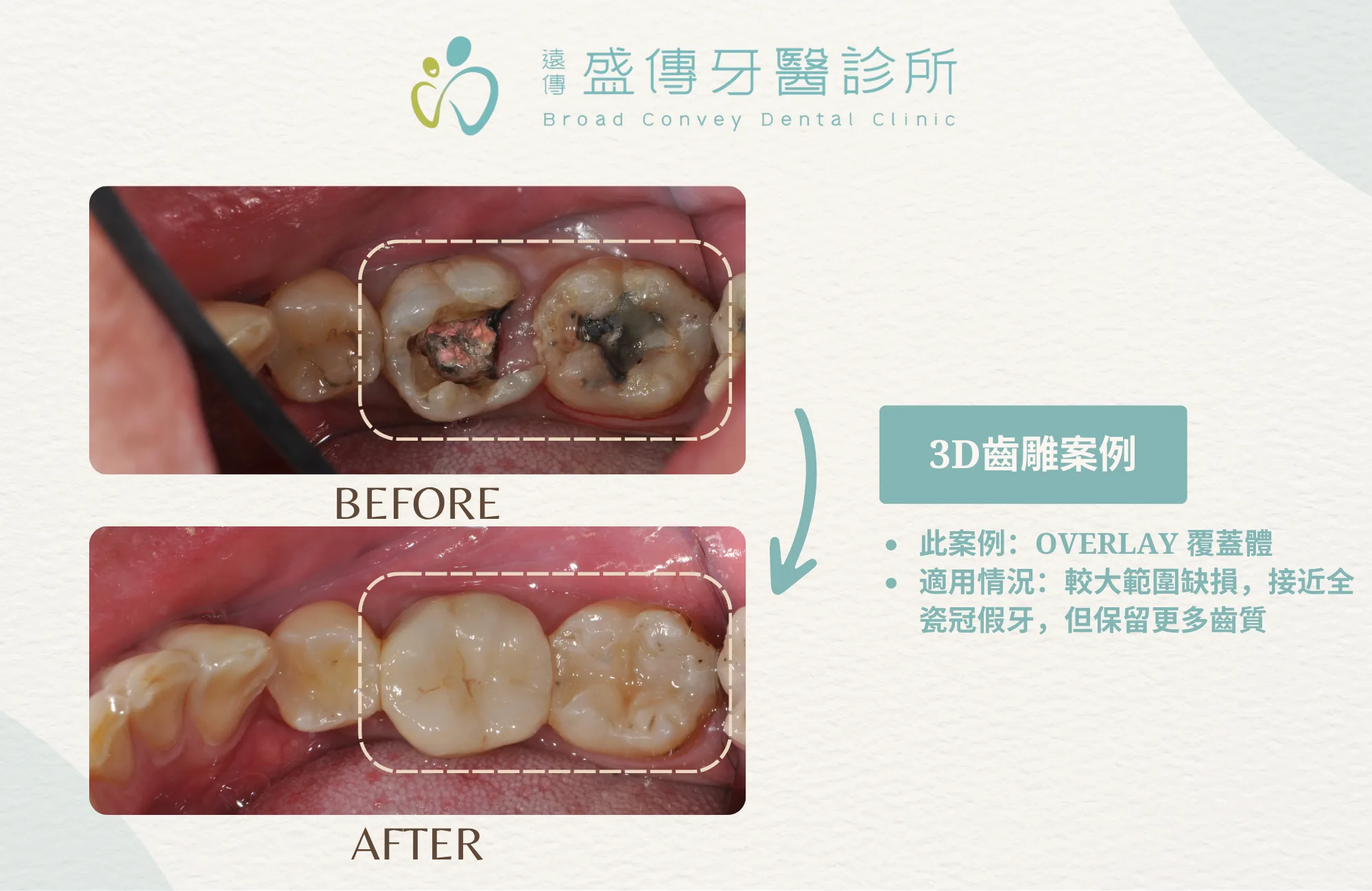 3D齒雕