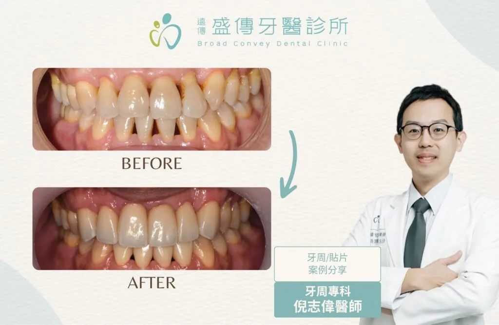 陳 貼片牙周 1