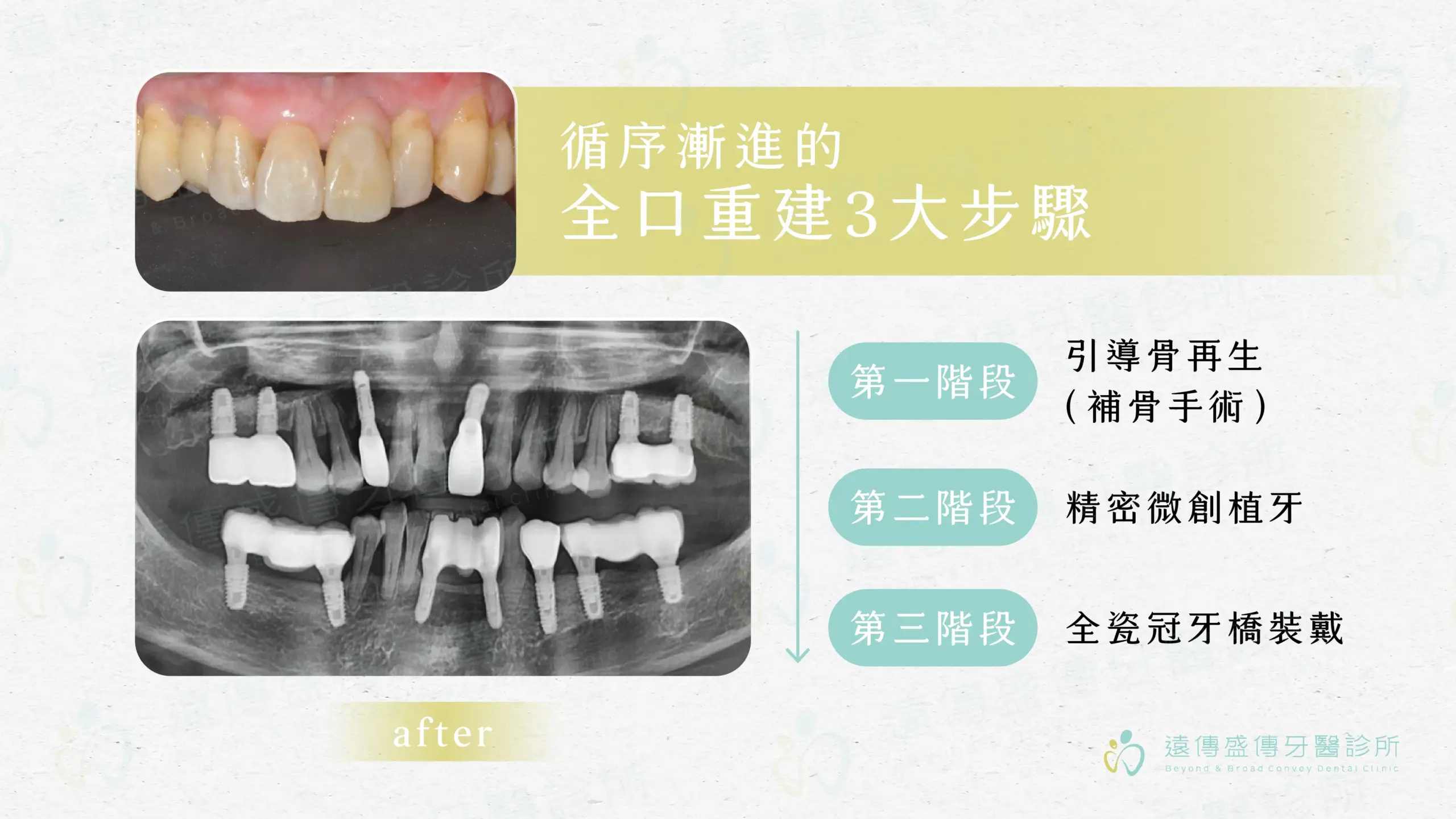 missing teeth implant bridge reconstruction 2 scaled