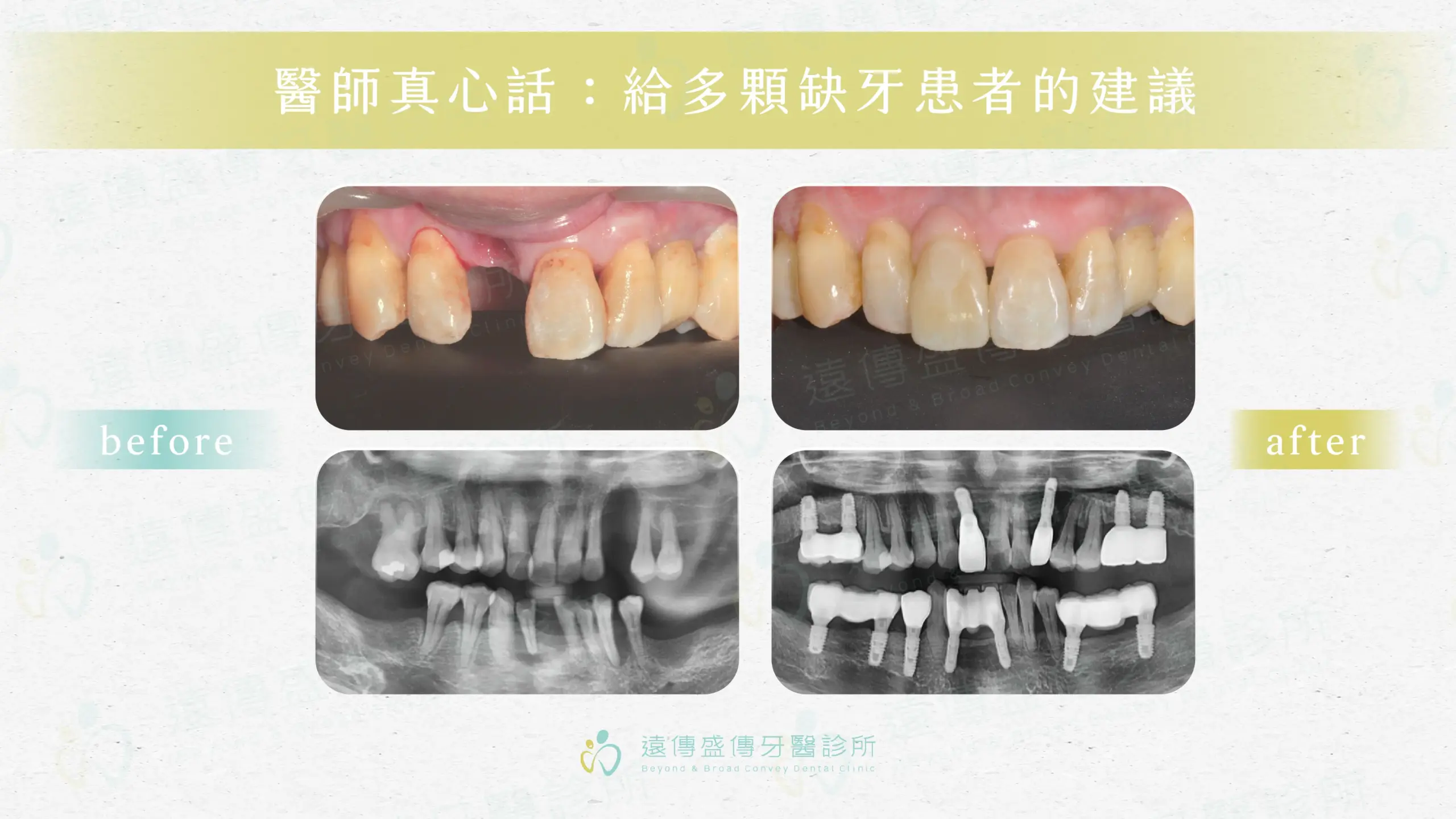 missing teeth implant bridge reconstruction 3 scaled