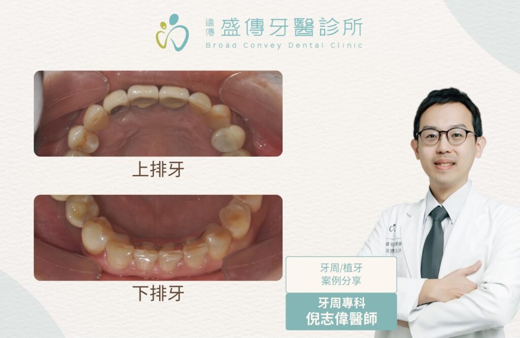 牙周植牙|為什麼有時需要先做牙周與矯正治療? 1 posterior missing teeth periodontal orthodontic implant case 01