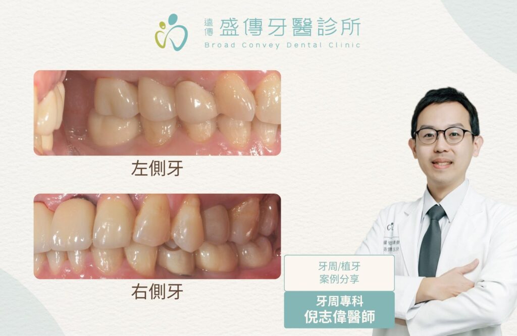 牙周植牙|為什麼有時需要先做牙周與矯正治療? 2 posterior missing teeth periodontal orthodontic implant case 02