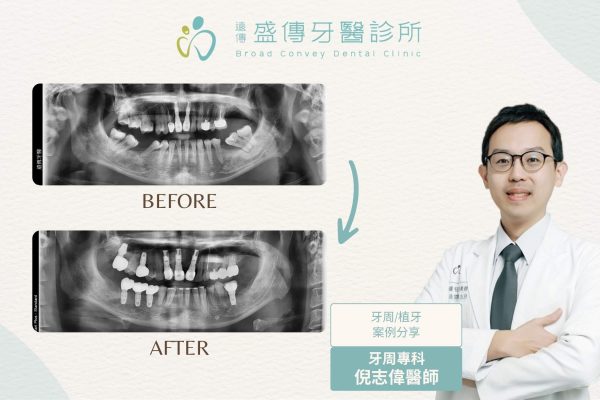 posterior-missing-teeth-periodontal-orthodontic-implant-case-03