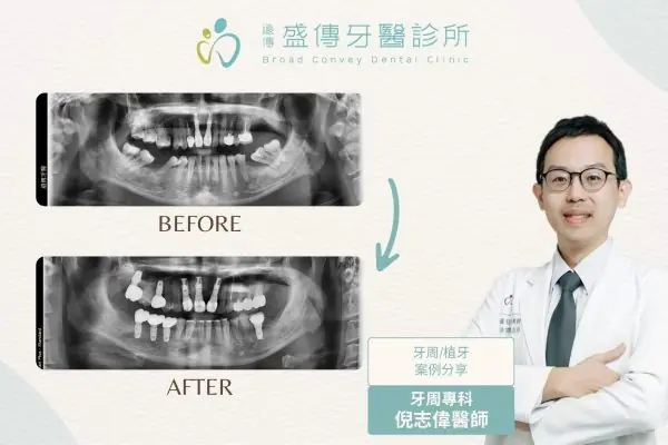 posterior-missing-teeth-periodontal-orthodontic-implant-case-03